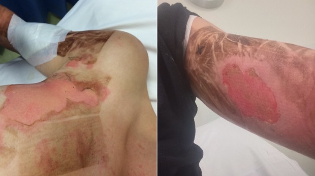 Burns to Ms Jones' arm and shoulder (Facebook)